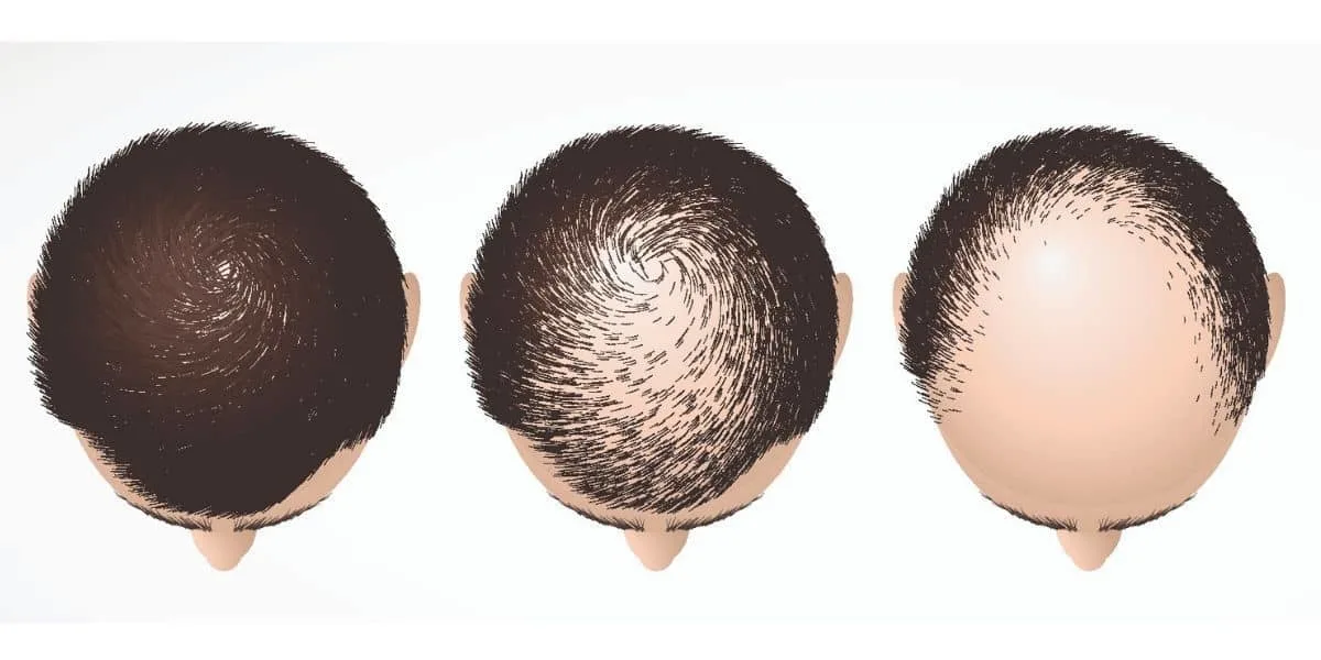 bald on top hair with hair on sides