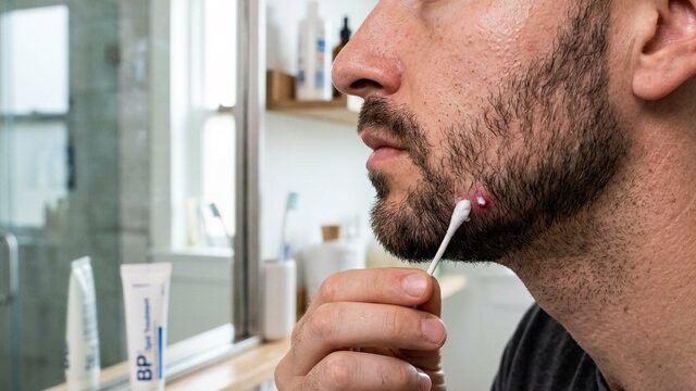 Men's acne treatment - ReadySleek